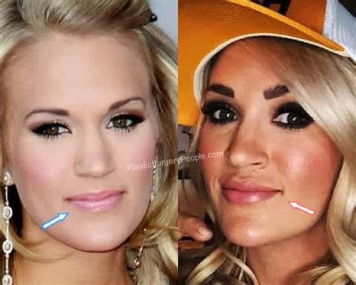 Unveiling Carrie Underwood's Lip Filler Journey: Before And After