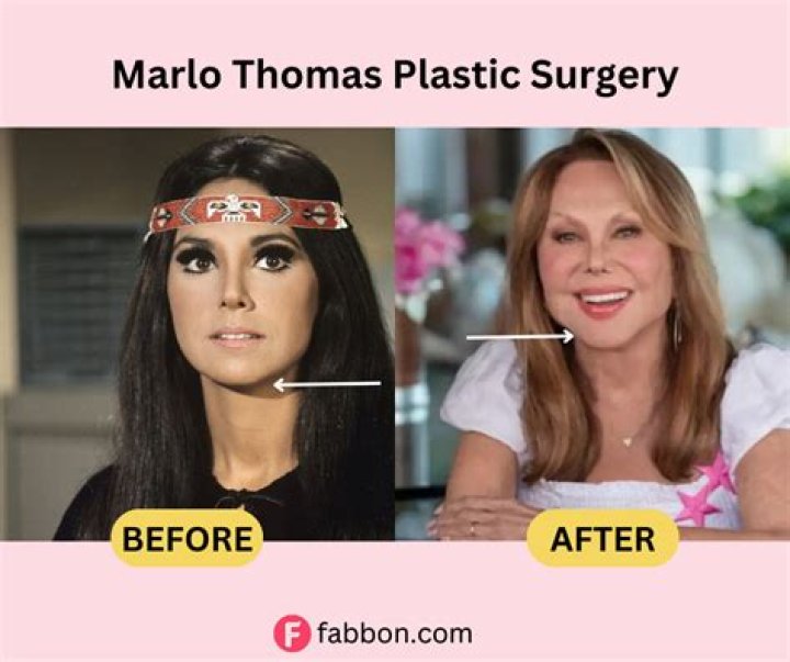 Has Marlo Thomas Undergone Plastic Surgery?