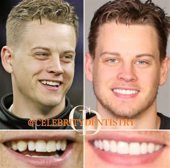 Uncover The Secrets Behind Joe Burrow's Unforgettable Teeth
