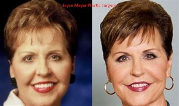 Joyce Meyer Face Surgery: Uncovering Truths And Unveiling Secrets