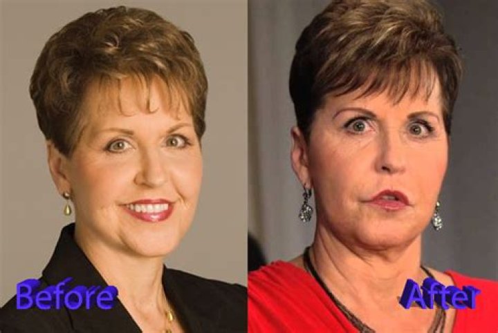 Uncover Joyce Meyer's Transformation: Before And After Plastic Surgery