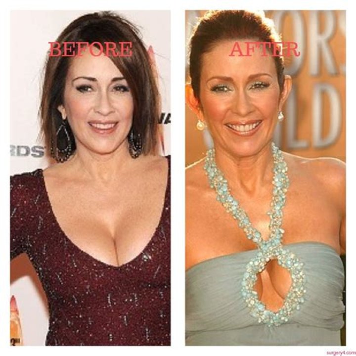 Patricia Heaton's Plastic Surgery Journey: Uncovering The Truths
